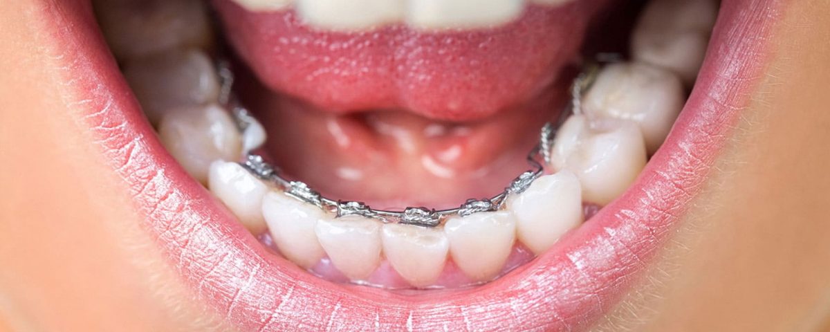 Lingual Ortodonti - Görünmeyen Diş Teli