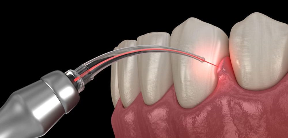 Lazer İle Dişeti Tedavisi | Diş Eti Hastalıkları Kapsamında; Diş Eti Kanaması | Diş Eti Çekilmesi | Diş Taşı Temizliği | Lazer ile Diş Eti Tedavisi | Diş Eti Estetiği