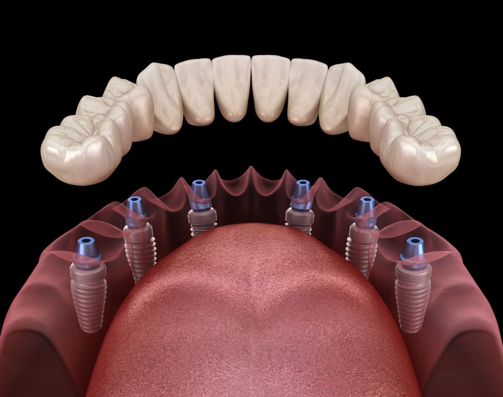 All-one-4-implants-i1