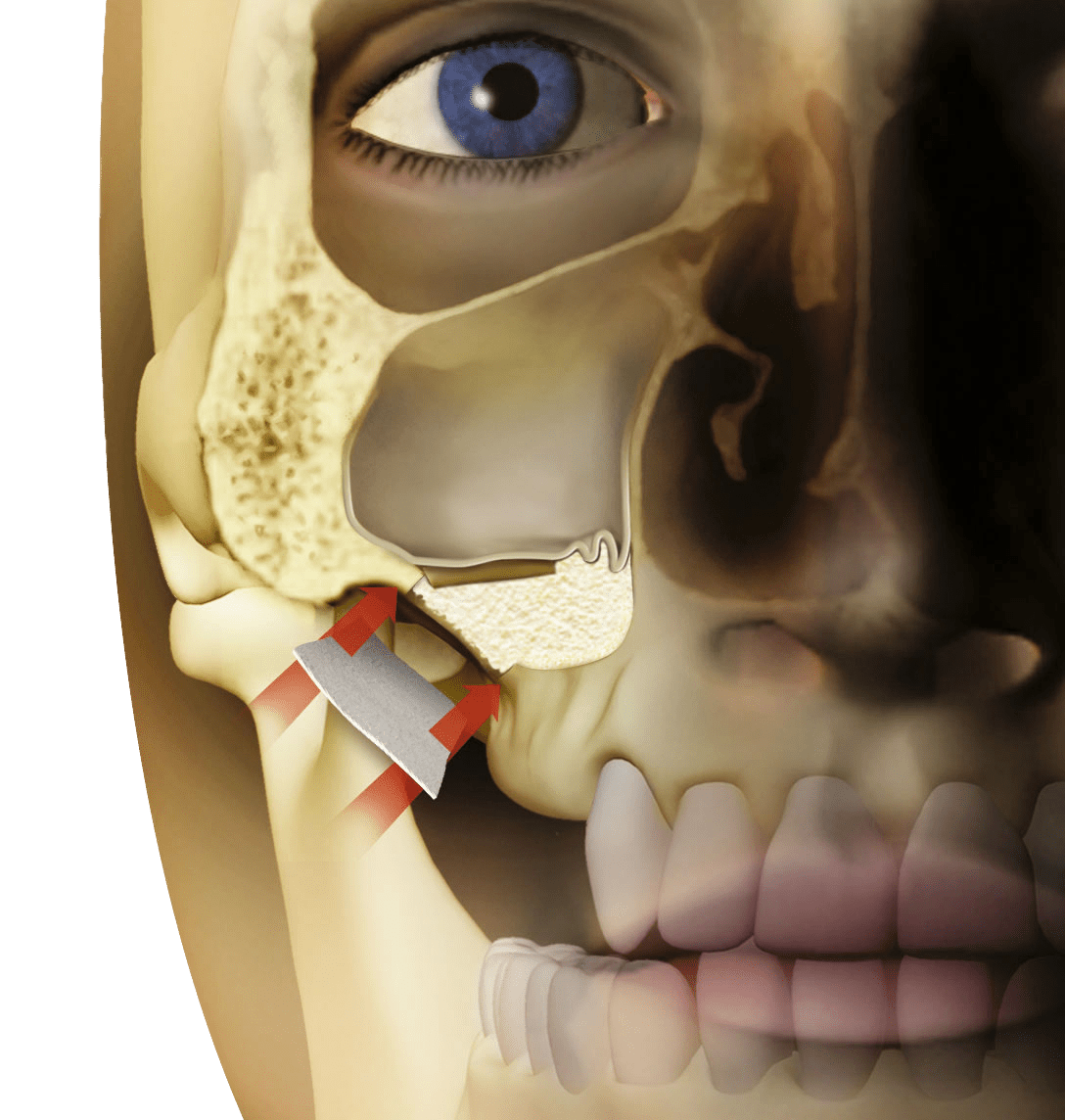 Sinus Lifting Sinus lift operations Medicadent Biological and