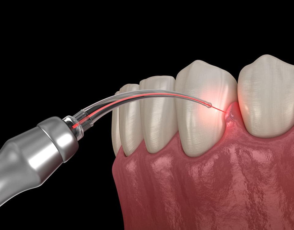 Lazer İle Dişeti Tedavisi | Diş Eti Hastalıkları Kapsamında; Diş Eti Kanaması | Diş Eti Çekilmesi | Diş Taşı Temizliği | Lazer ile Diş Eti Tedavisi | Diş Eti Estetiği