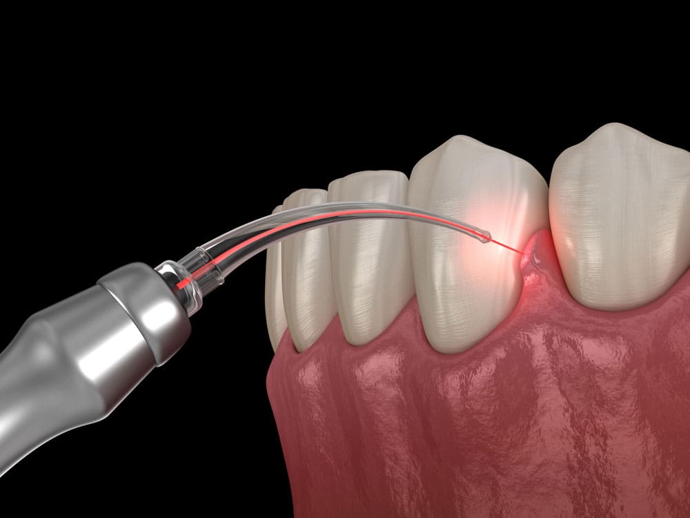 Lazer İle Dişeti Tedavisi | Diş Eti Hastalıkları Kapsamında; Diş Eti Kanaması | Diş Eti Çekilmesi | Diş Taşı Temizliği | Lazer ile Diş Eti Tedavisi | Diş Eti Estetiği